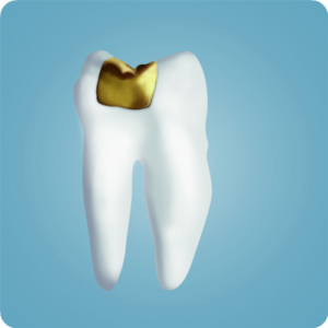 Gold-Inlays